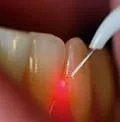 laser root canal