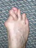 Foot with a Bunion