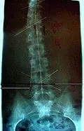 Before X-ray