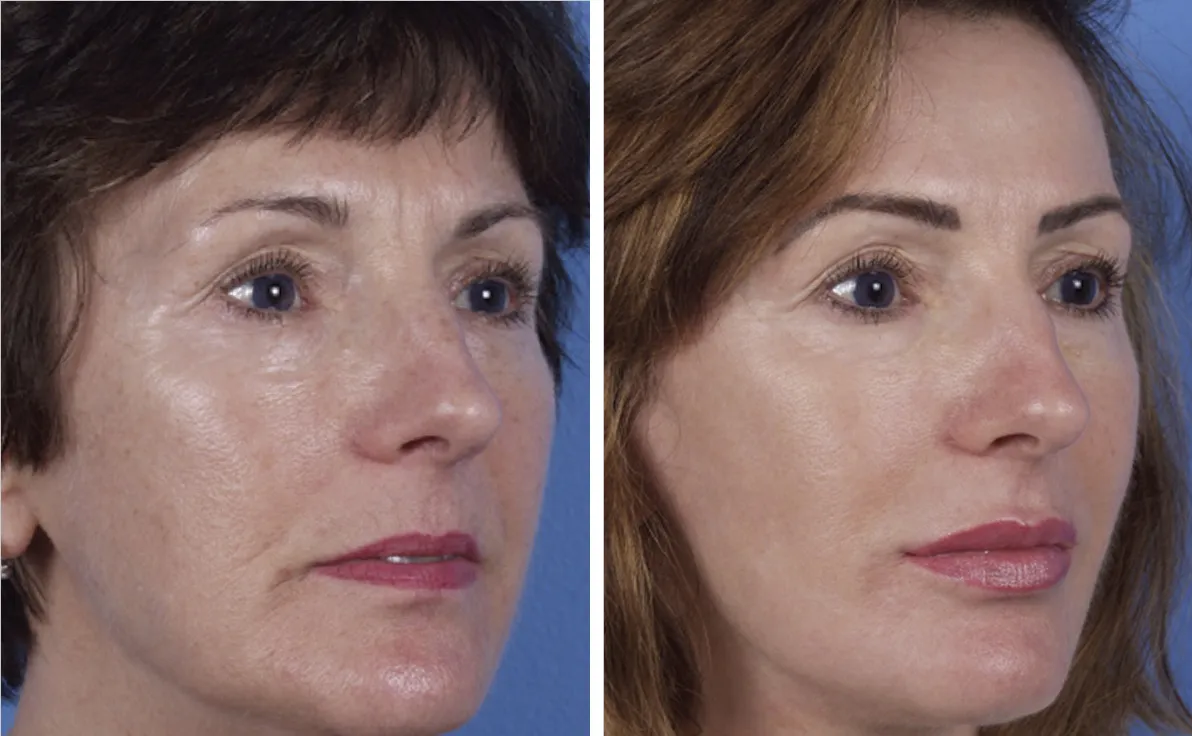 MicroLaserPeel