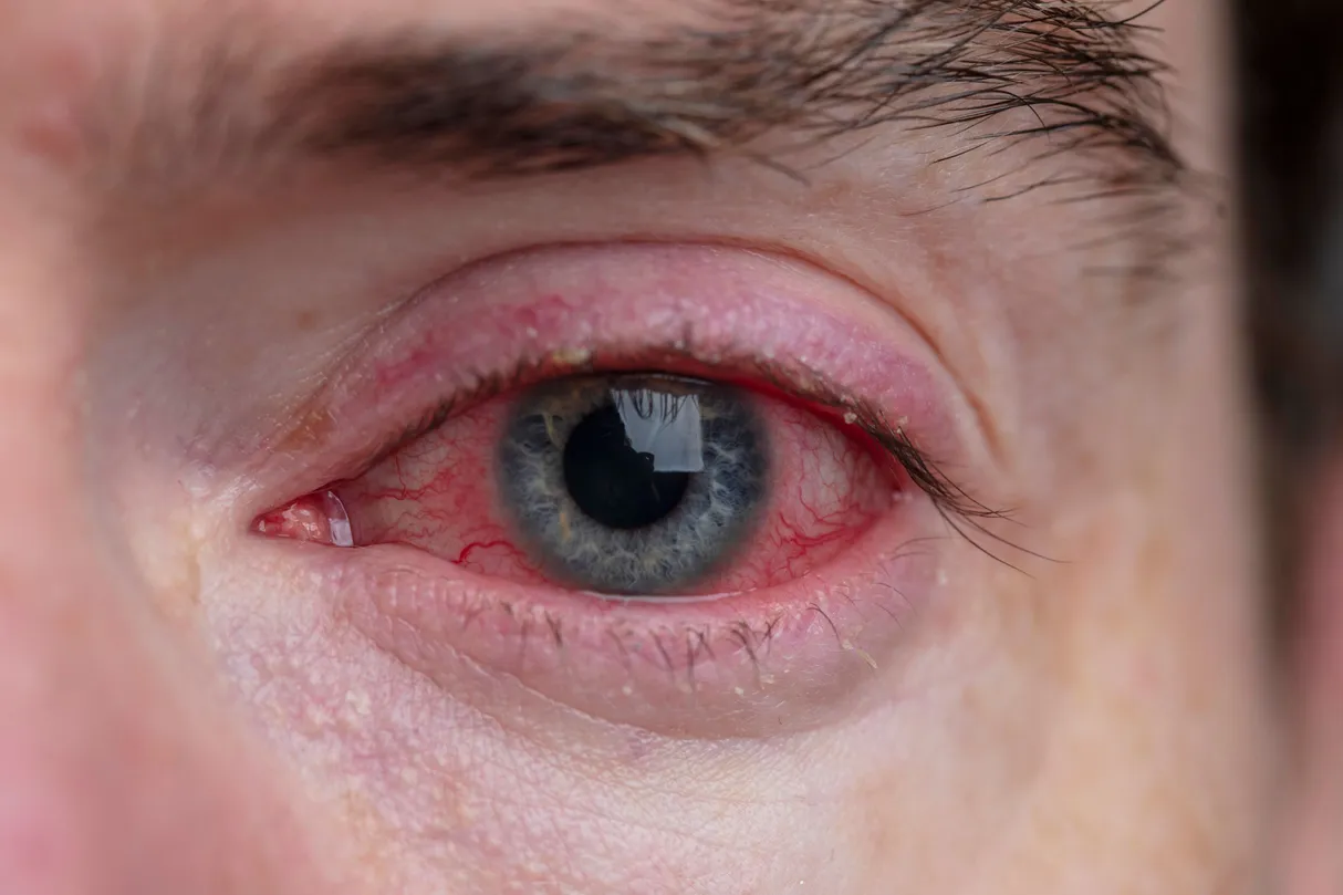 Conjunctivitis