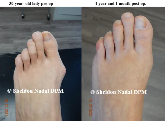BEFORE &copy; Sheldon Nadal DPM AFTER