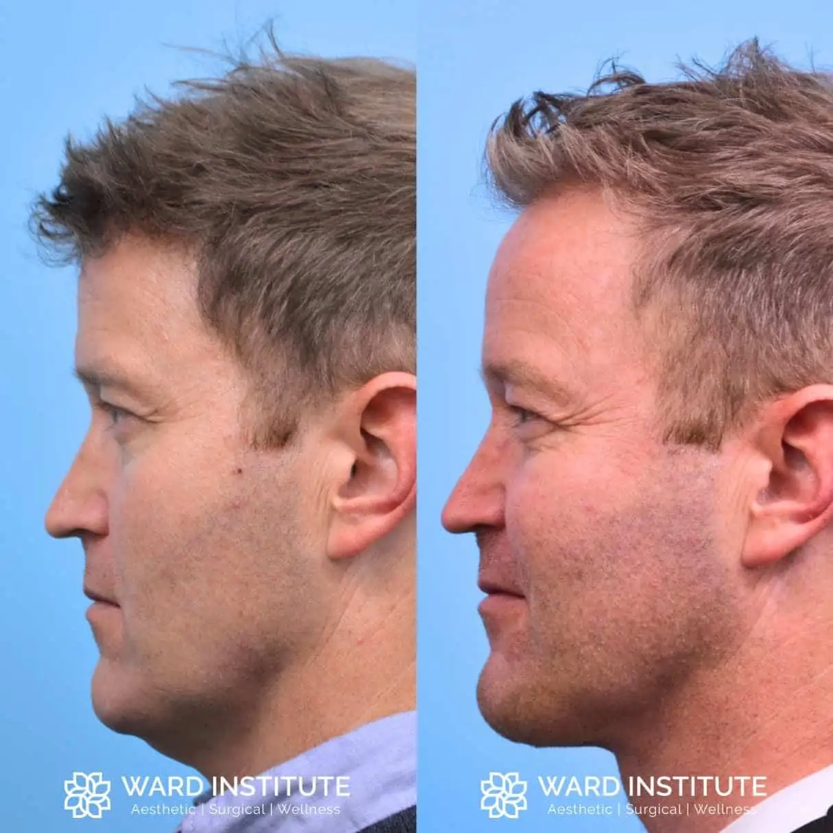 Before and after image of a chin augmentation.