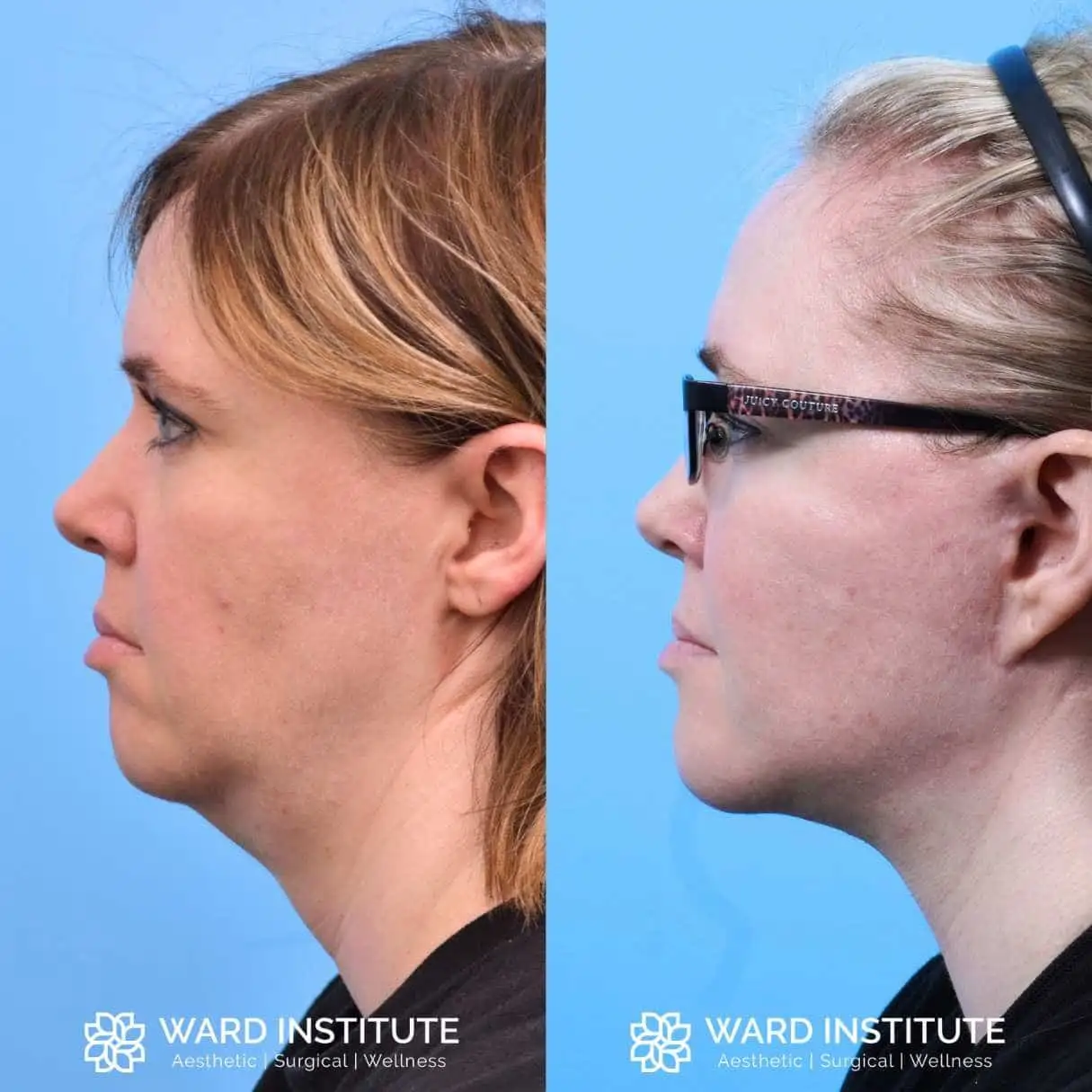 Before and after image of a chin augmentation.