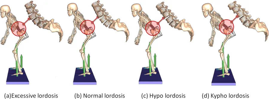 TPI Golf Swing Posture St Pete Chiropractor Burghealth