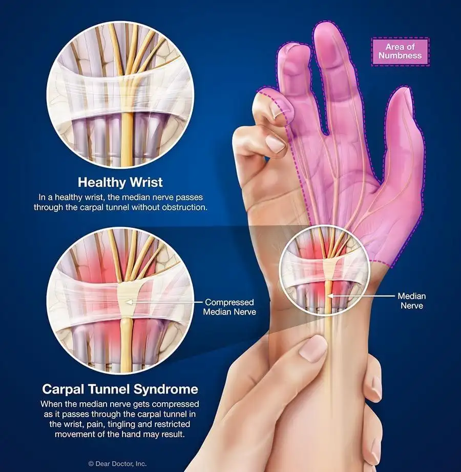 Carpal Tunnel Syndrome Basalt Aspen Carbondale