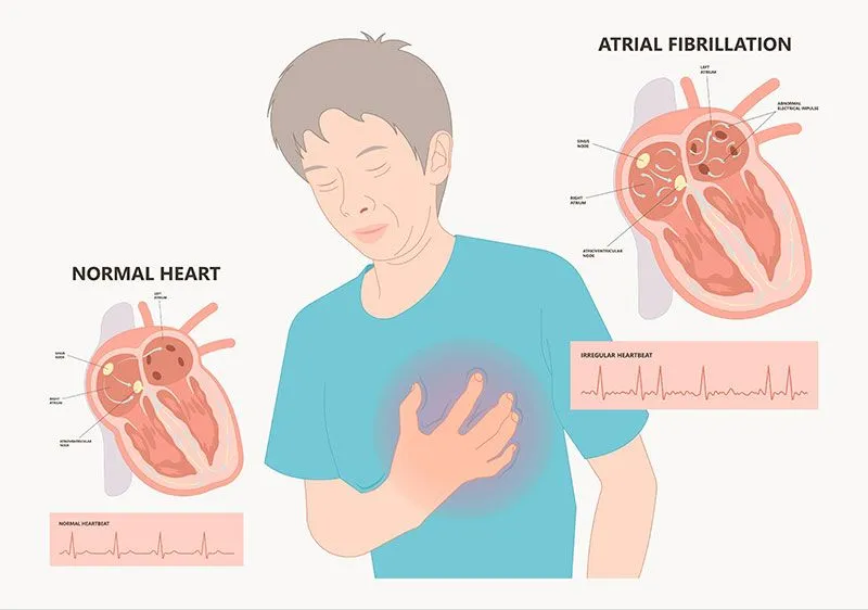 atrial fibrillation