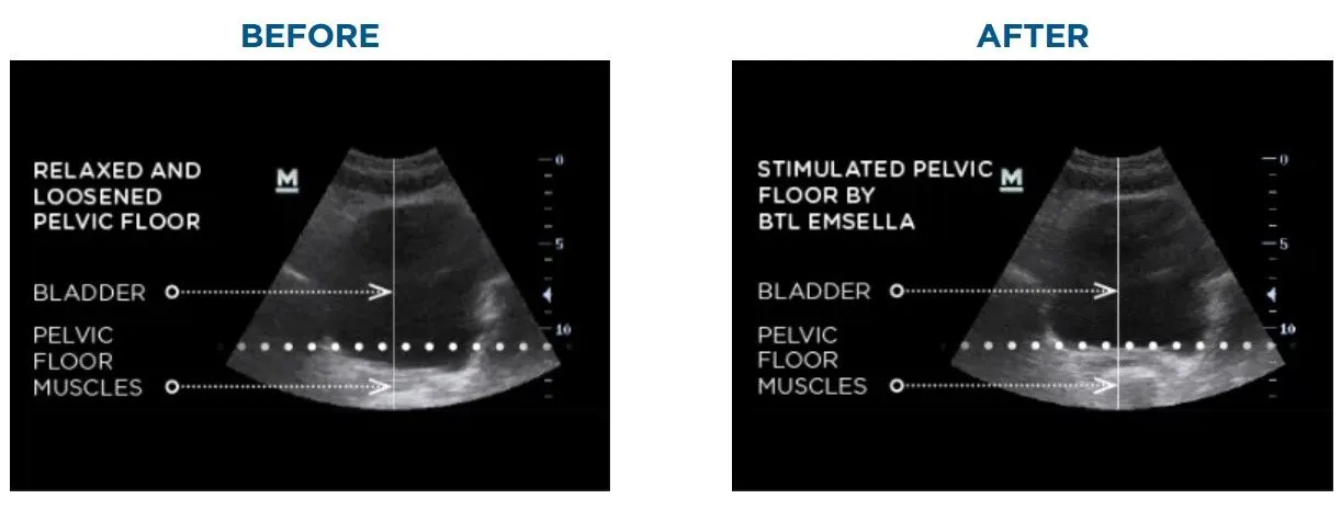 emsella-before-after