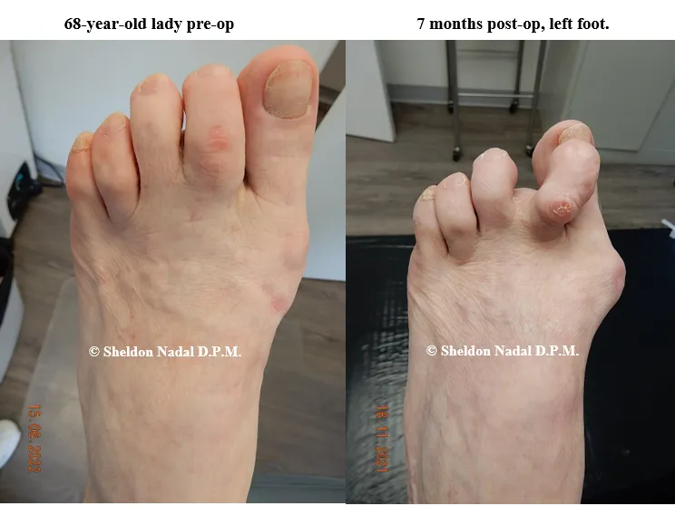 BEFORE &copy; Sheldon Nadal DPM AFTER