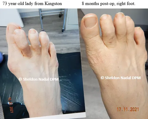 BEFORE &copy; Sheldon Nadal DPM AFTER