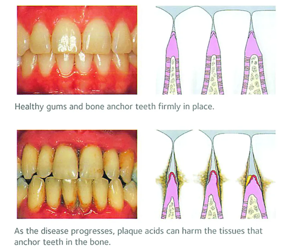 Health Gums and Gum Disease