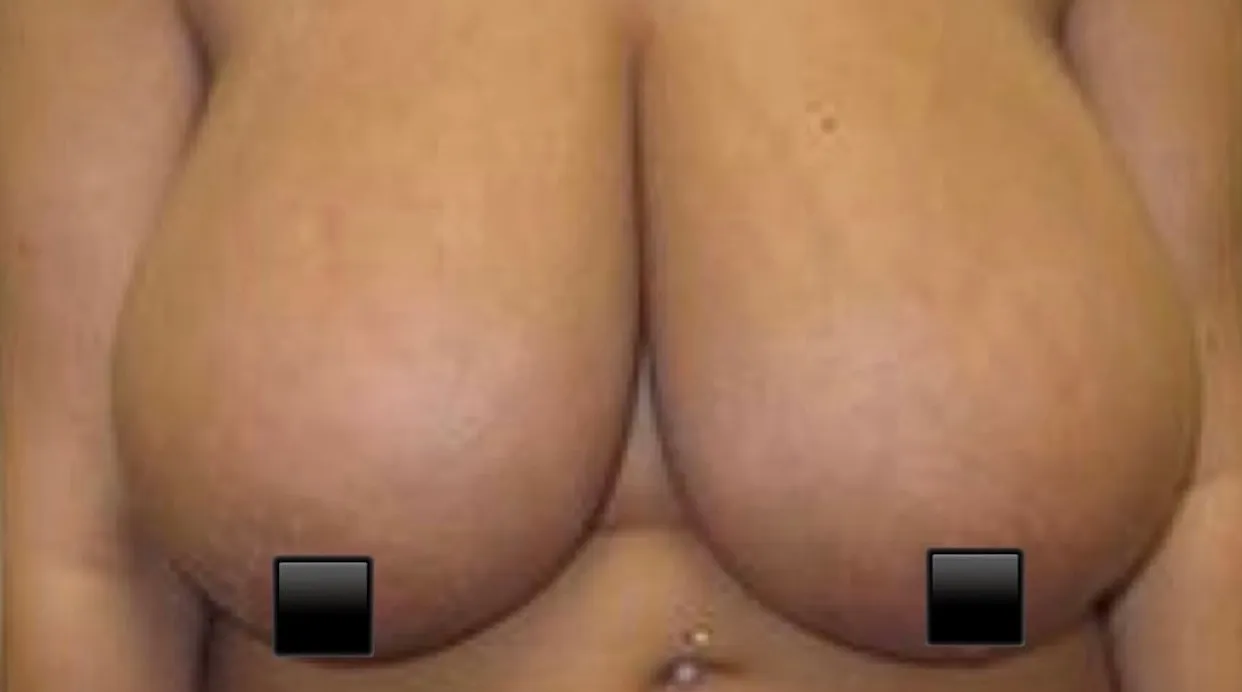 Breast Reduction Before