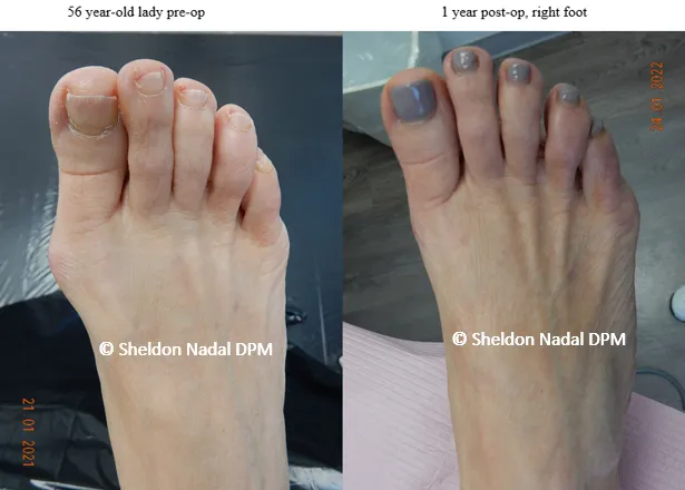 BEFORE &copy; Sheldon Nadal DPM AFTER