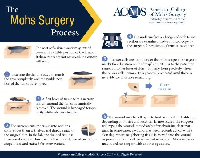 Mohs Surgery
