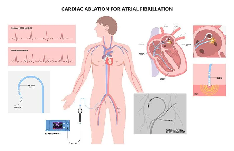 afib ablation