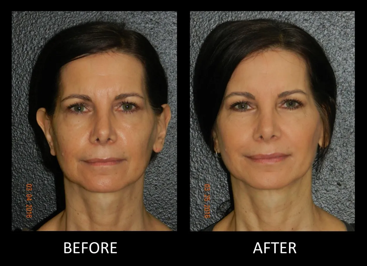 Facial Fillers in Montrose, Houston, TX