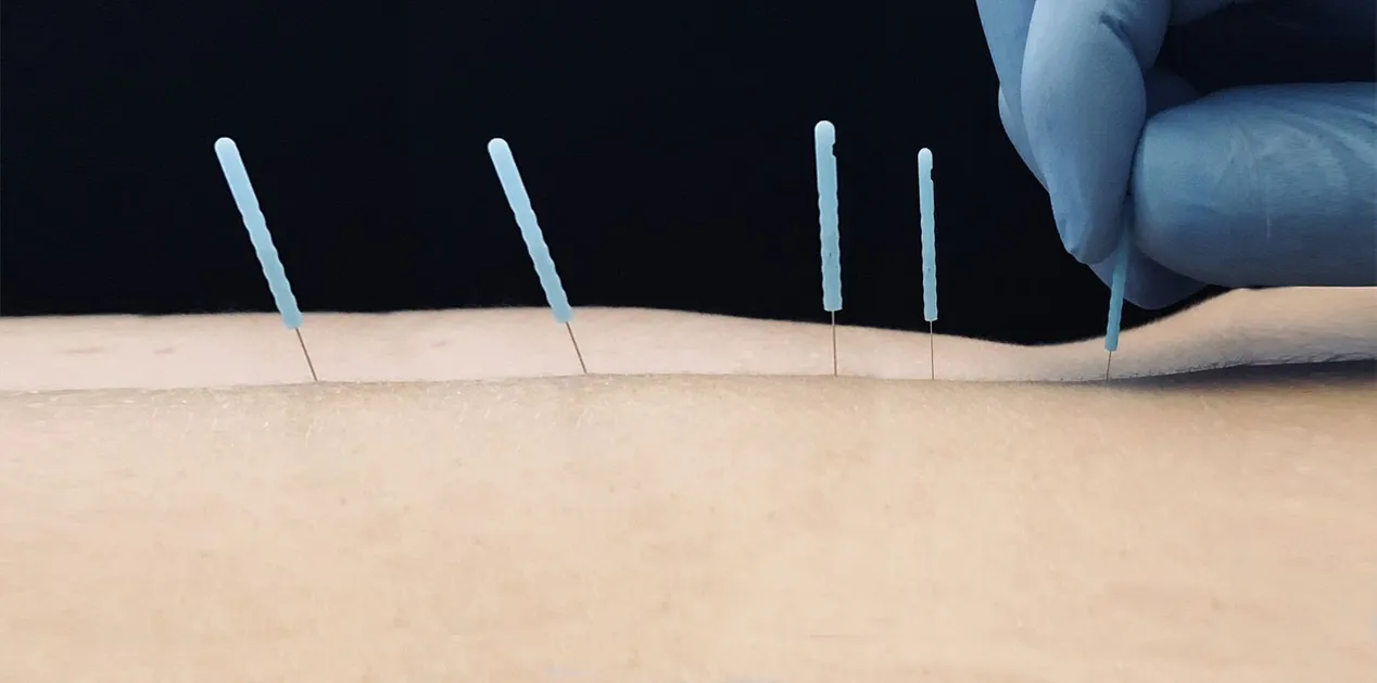 acupuncture