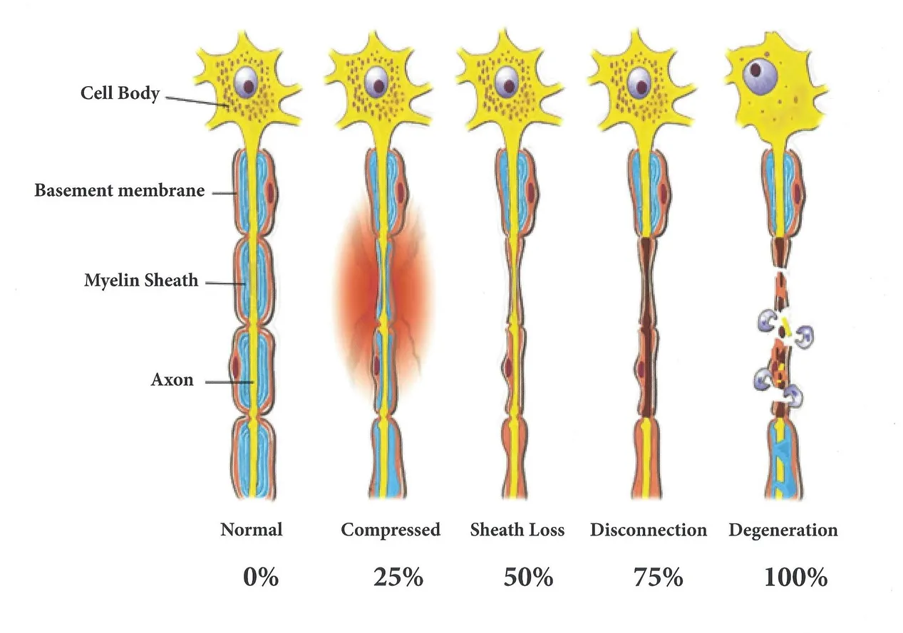 Neuropathy Degeneration