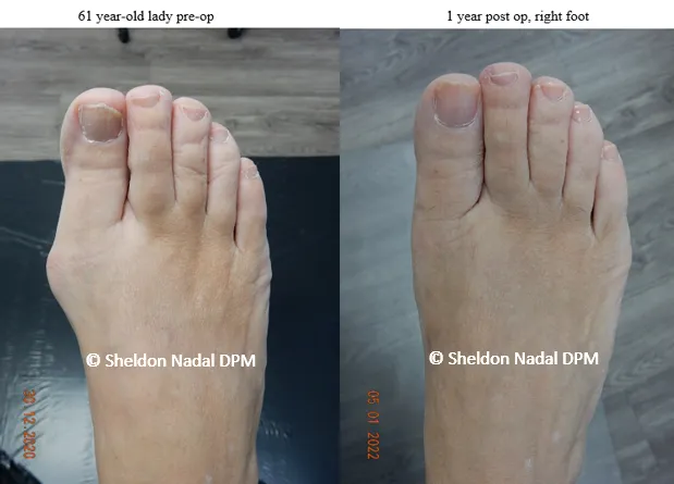 BEFORE &copy; Sheldon Nadal DPM AFTER