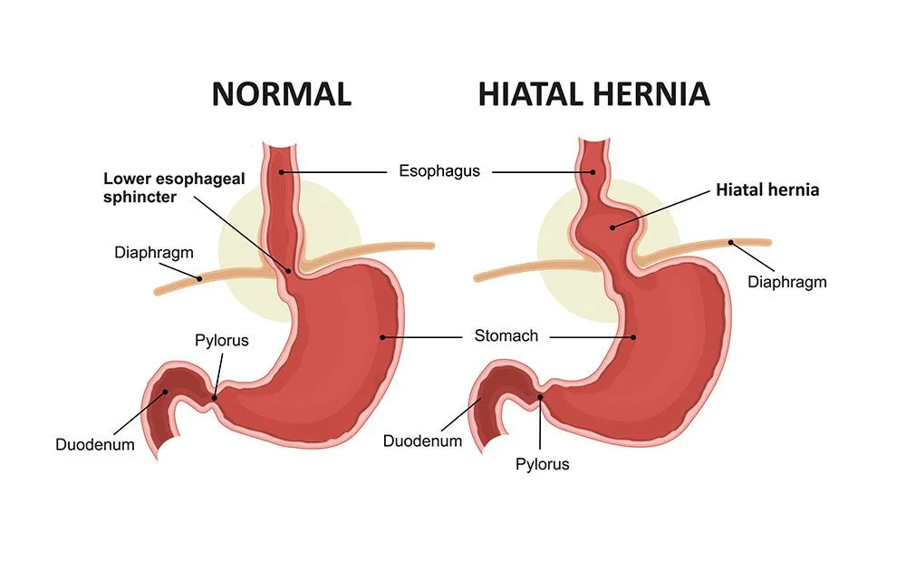 hernia