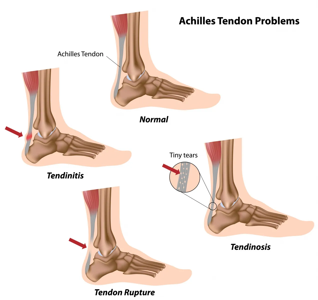 What is the reason for foot pain? - Rela Hospital