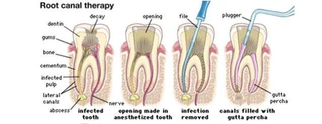 Root_canal_1.jpg