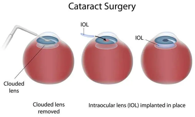 Cataract Surgery FAQs