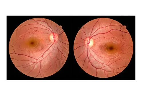 Macular_Degeneration_FAQ