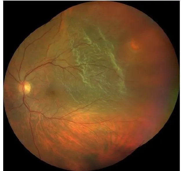 Retinal Tear 