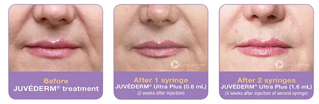 Juvederm before and after