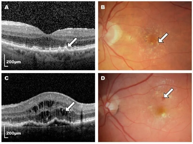 Severe Optic Nerve Damage