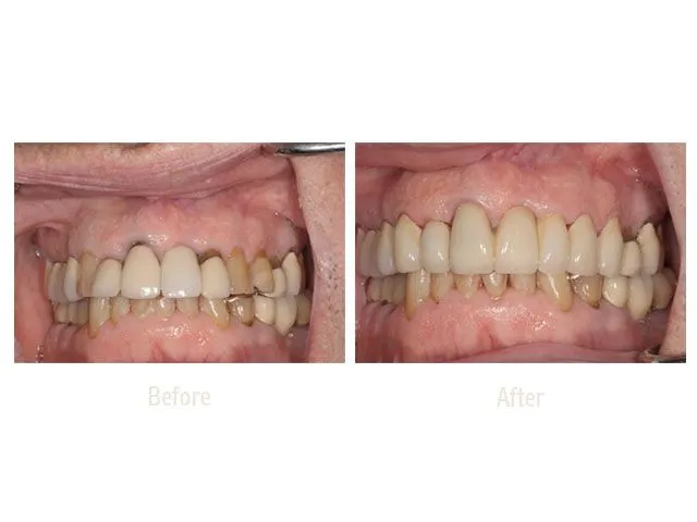 Before Treatment and After Treatment