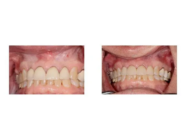 Before and After Color Correction with Ceramic Restoration