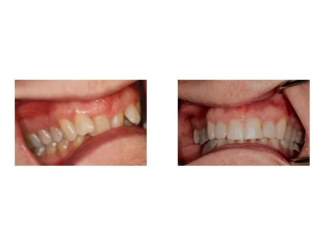 Before and After Treatment with Invisalign