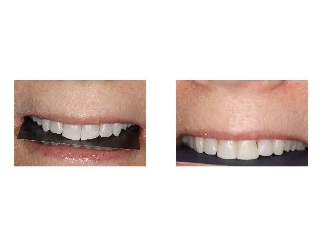 Before and After Restoration with Bonded Restoration