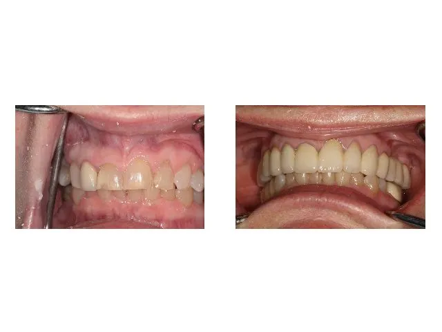 Before and After Dental Treatment