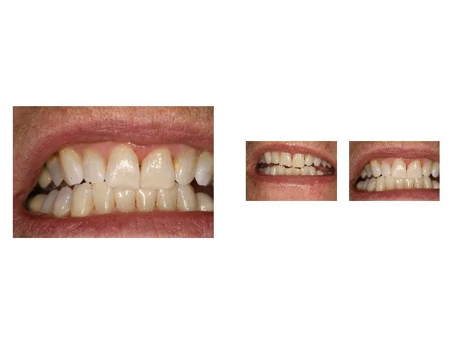 Dr. Tekle, Before and After photo of straightened teeth