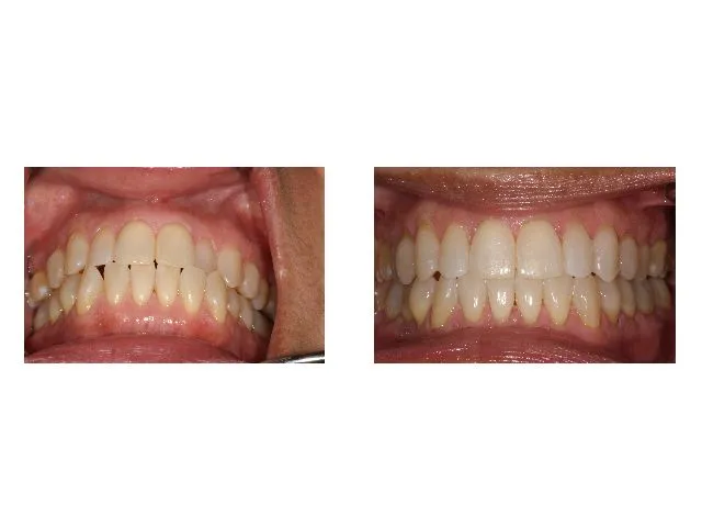 Before and After Dental Treatment