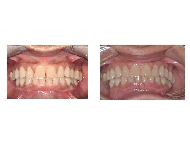 Before and After Dental Treatment