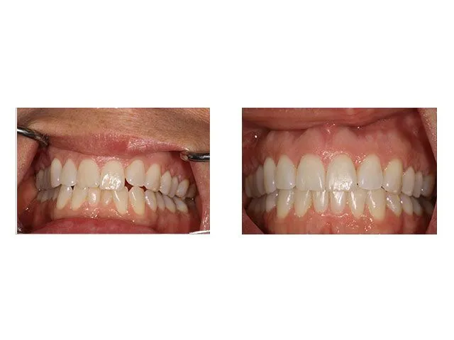 Before and After Dental Treatment