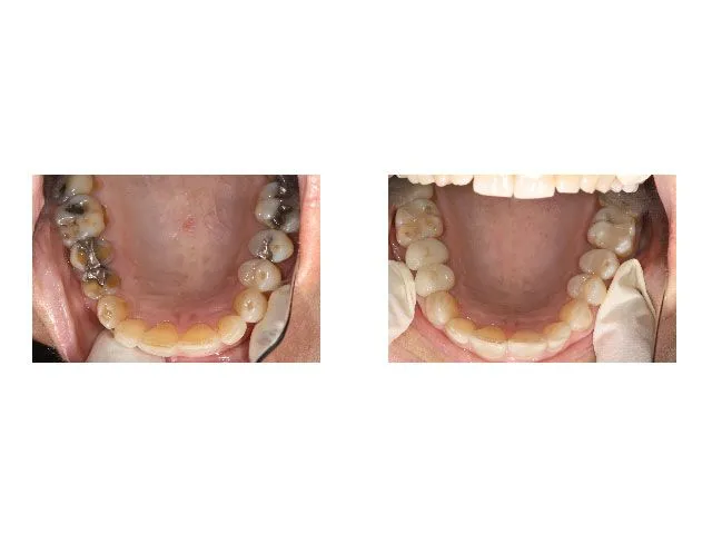 Before and After Treatment with Ceramic Crowns and Bonded Restoration