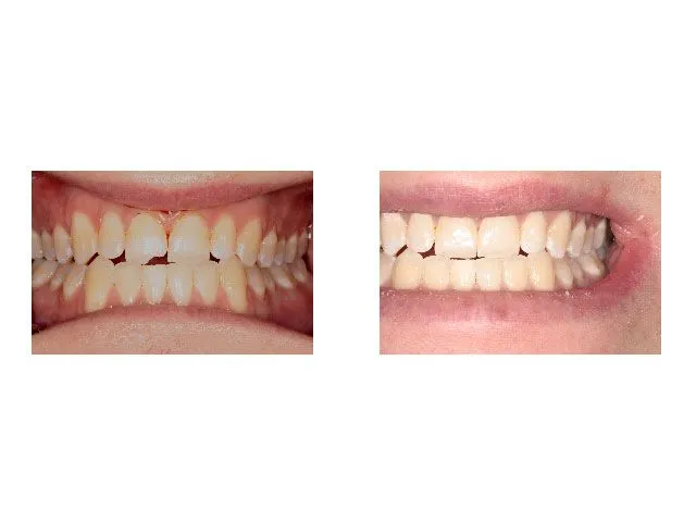 Before and After Treatment with Bonded Restoration