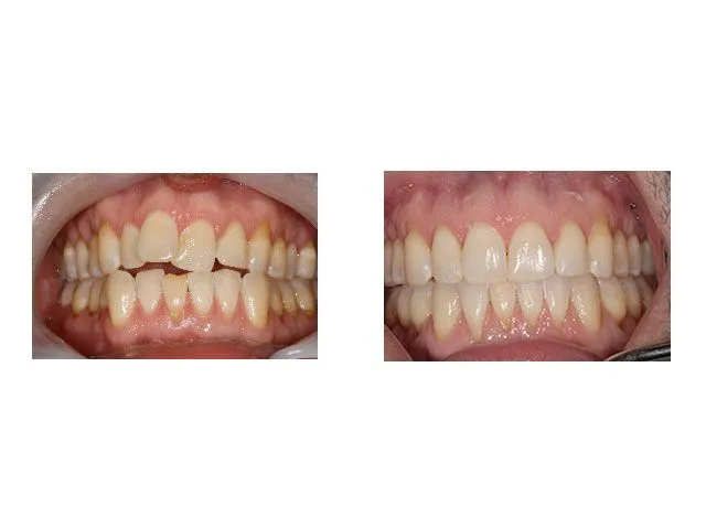 Before and After Treatment with Invisalign