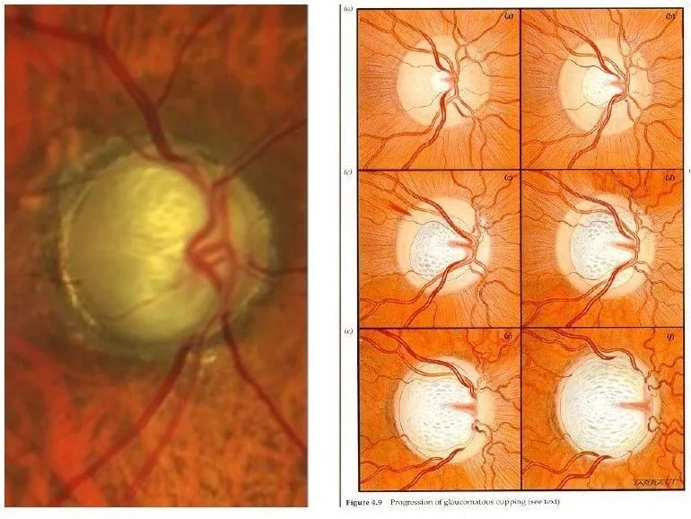 Severe Optic Nerve Damage 