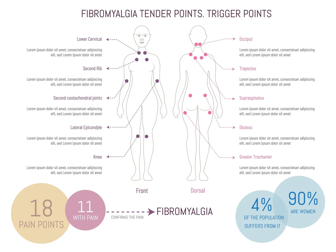 Fibromyalgia