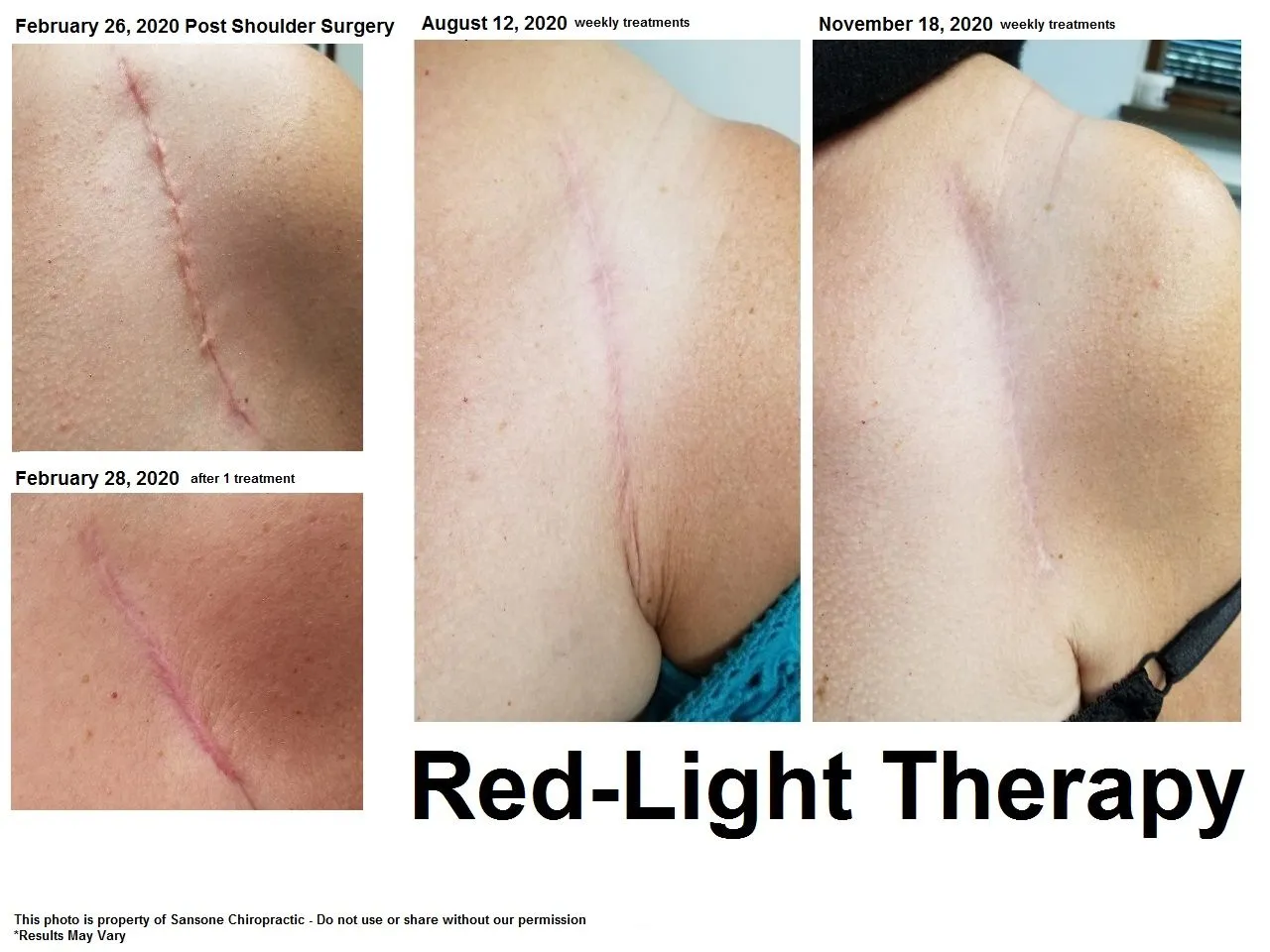 RLT Post surgical scar