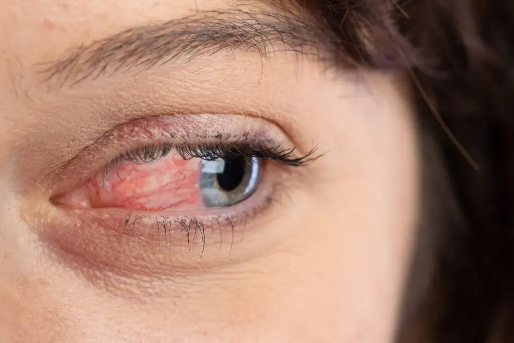 ocular rosacea