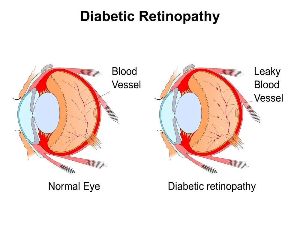 eye diseases