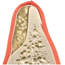 Tustin bone grafting during healing