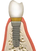 Tustin bone grafting with dental implant